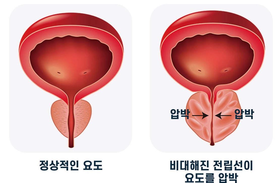 건강한 전립선을 유지하는 것이
왜 중요할까요?